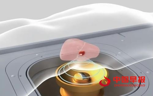 关爱健康,无创守护 | 苏州名仕医院“高强度超声聚焦无创治疗"筛查活动开启(图3) 关爱健康,无创守护 | 苏州名仕医院“高强度超声聚焦无创治疗"筛查活动开启(图3)