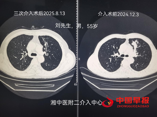 湖南中医药大学放射介入中心创新治疗模式显奇效(图1)